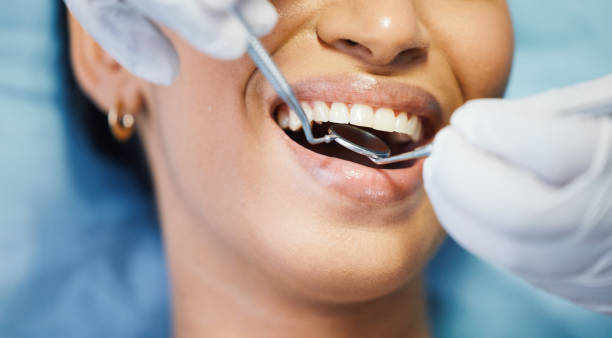 Emergency Dental Filling Replacement in FL